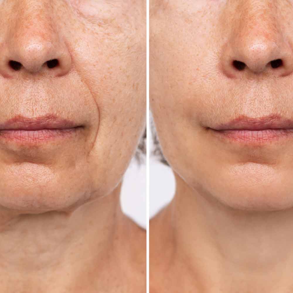 Facelift-without-price-analysiss