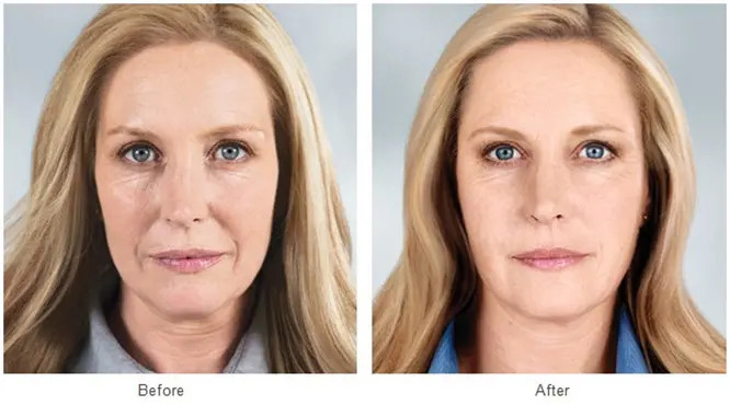 Why-is-it-recommended-to-do-a-facelift-without-surgery