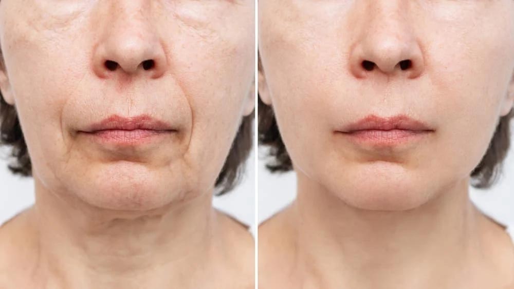 Why-is-it-recommended-to-do-a-facelift-without-surgeryy